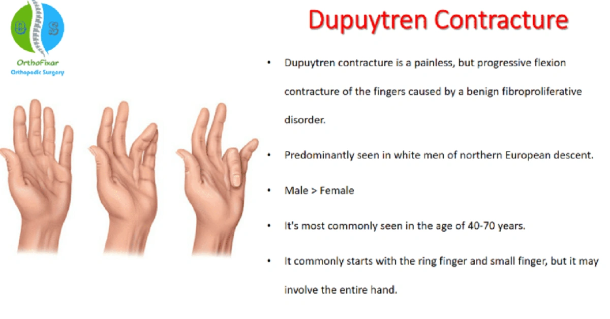 Dupuytren’s Contracture: A Comprehensive Review of Pathophysiology, Diagnosis, and Management